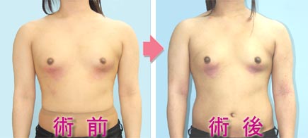 肩幅の広いのを狭くする手術 怒り肩を治す手術 美容外科ヤスミクリニック