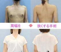 肩幅を狭くする手術（鎖骨骨切り）