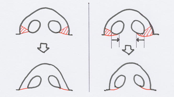 kobana_resection