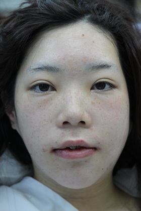 顎・エラ・頬骨削り後の顔の腫れ