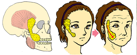 バッカルファット切除で頬のタルミが取れる？