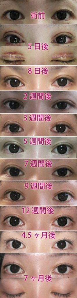 二重全切開の経過 腫れと幅 傷 美容外科ヤスミクリニック