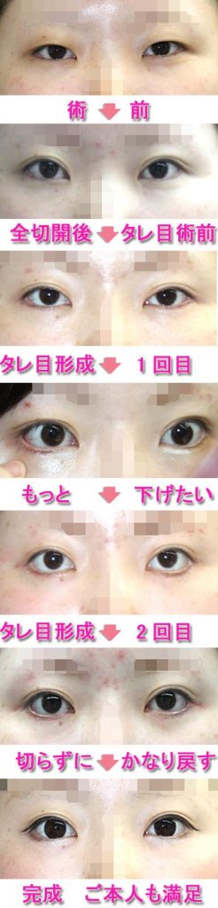 タレ目形成2回目やって後悔 だいぶ戻して完成 美容外科ヤスミクリニック タレ目形成2回目やって後悔 だいぶ戻して完成 美容外科ヤスミクリニック
